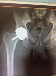 My hip resurfacing has failed. So back in for a revision. June 4th 2015